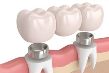 Caring for Your Dental Crown: Some Tips for Longevity