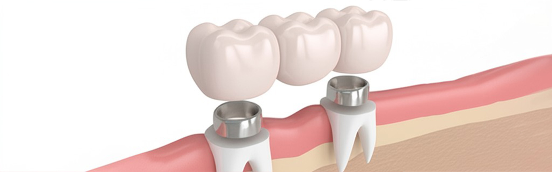 Caring for Your Dental Crown: Some Tips for Longevity