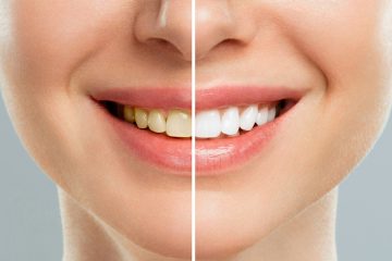 Natural Teeth Whitening Remedies: Do They Actually Work?