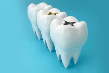 Composite Fillings vs. Silver Fillings: Which Is Right for You?